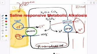 Metabolic Alkalosis (Saline responsive Vs Saline Unresponsive) with hypokalemia and hypochloremia