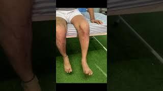 Rom exercises post surgery of tibial condyle part -1 #nopainnogain #physiotherapy #recovery #rom