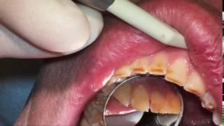 Dental video used for patient education