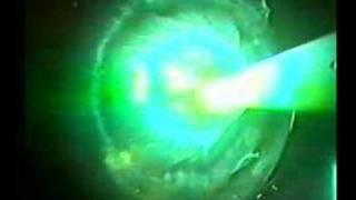 the Anatomy of the Vitreous Body - 1 of 2