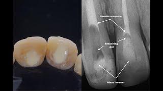 Internal Bleaching Case Presentation