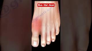 Big toe pain