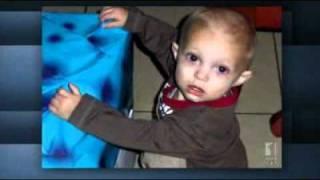 Infant autopsy reveals history of abuse