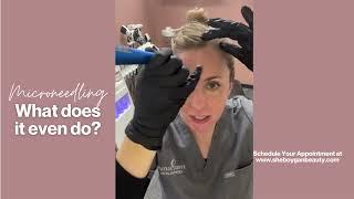 Why I LOVE Microneedling for almost any skin type!