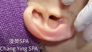 清粉刺推薦耳朵黑頭Blackheads on ear Removal!! (耳の角栓/耳掃除)