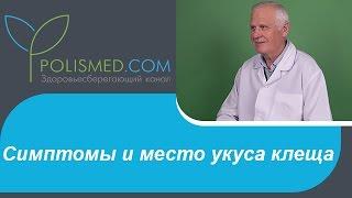 Симптомы и место укуса клеща. Сколько живет клещ после укуса. К какому врачу обращаться