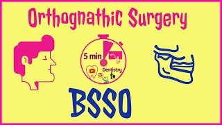 BSSO - BILATERAL SAGITTAL SPLIT OSTEOTOMY | ORTHOGNATHIC SURGERY | 5 min DENTISTRY easy notes