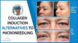 Collagen Induction Therapies - Alternatives to Microneedling