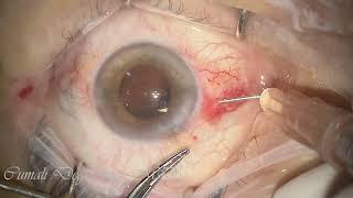 Telegin technique in patient with zonular dialysis and anterior capsular rupture