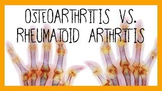 Osteoarthritis vs. Rheumatoid Arthritis