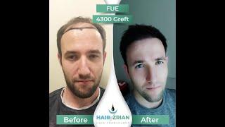 Hair Transplant Turkey, Hair of Zrian, FUE, 4300 Graft