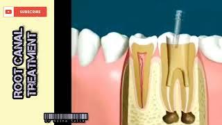 Root Canal Complete process animation video | Dr Ajina Salim