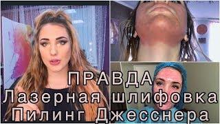 ОТЛИЧИЕ ЛАЗЕРНОЙ ШЛИФОВКИ ОТ ПИЛИНГА ДЖЕССНЕРА