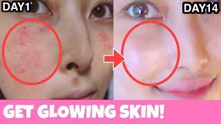 Facial Exercises For GLOWING SKIN! Prevent Acne, Scars, Pigmentation | Anti-Aging, Face Lift