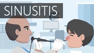 What is Sinusitis?