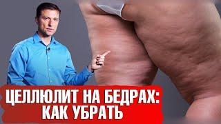 Как избавиться от целлюлита на бедрах? Почему появляется целлюлит? 