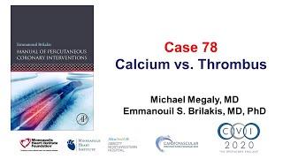 Case 78: PCI Manual - Calcium vs thrombus