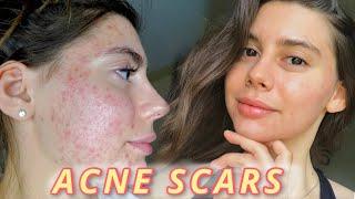 MY SECRETS TO HEAL ACNE SCARS FAST: Struggling With Pigmentation