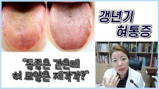 갱년기 혀통증 - 혀가 아픈건 똑같지만 혀 색깔에 따라 치료법은 다르다