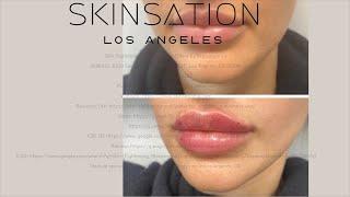 Skin Tightening, Botox and Lip Fillers by Skinsation LA - Lip fillers near me