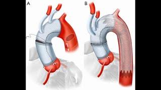 Simplifying aortic arch surgery: open zone 2 with single branched endovascular aortic repair