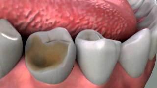 Crowns Core Build Up Procedure