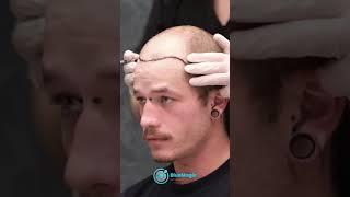 Hair Transplant Surgery | Using The Latest Technology & Techniques