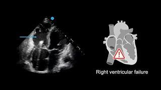 Recognizing poor right ventricular systolic function in echocardiography