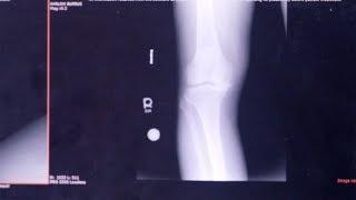 Total Knee Replacement - Yale Medicine Explains