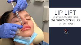 Lip Filler Lip Lift with the Russian Technique