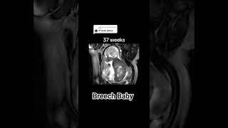 37 Weeks breech baby #breechbaby #babyultrasound #baby #pregancyultrasound