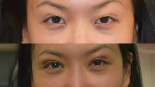 #ChaseLayMD 7 time Revison Asian Eyelid Surgery