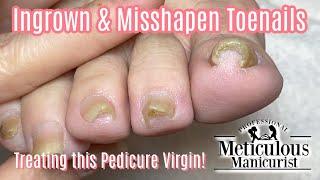 How To Transformation Squeezed Ingrown Toenail Pedicure 