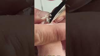 Crazy satisfying Nail Fungus Removal - Eww! #110