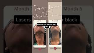 Are lasers safe in black skin? | Dr Alexis Stephens