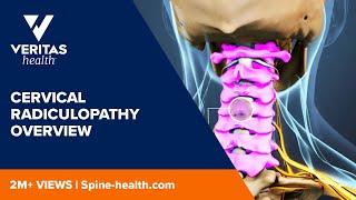 Cervical Radiculopathy Overview