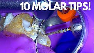 Top 10:  Molar Root Canal Tips To Make Life Easier