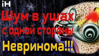 Шум в ушах с одной стороны? Может быть невринома | iНЕВРОЛОГ