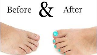 Toenail Treatment - Miracle Gelous Reconstruction