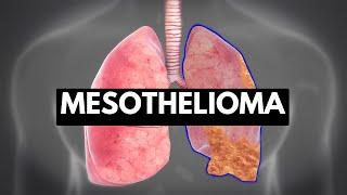 MESOTHELIOMA, Causes, Signs and Symptoms, Diagnosis and Treatment.