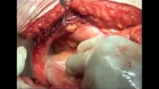 STOPPA BILATERAL RECURRENT INGUINAL HERNIAS HENARES HOSPITAL