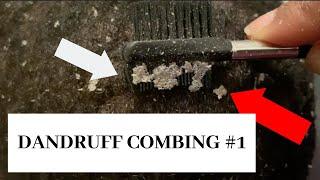 Dandruff combing #1  BIG FLAKES