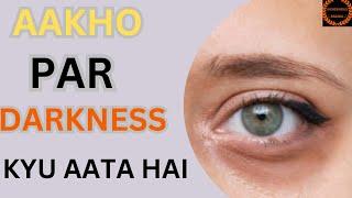 Treating Dark Circles Under Your Eyes | | आंखों के नीचे काले घेरे: समझें और इलाज करें" || HARIOM