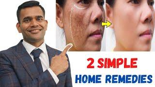 15 Days Challenge Remove Dark Spots Acne Scars Pimples marks And Pigmentation