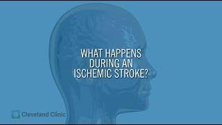 What Happens During an Ischemic Stroke