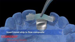 Maryland Bridge - Indirect Procedure