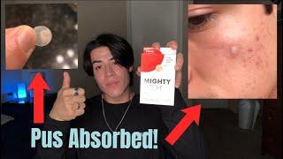 Hero Mighty Patch Review (Original) *Everyone NEEDS These PIMPLE Patches*
