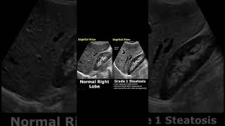 Fatty Liver Grading On Ultrasound | Hepatic Steatosis Grades 1,2,3 | Normal Vs Abnormal USG #shorts