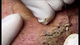 The MOST Extreme Nose Acne Black Heads You Have Ever Seen !