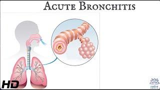 Acute bronchitis: Everything You Need To Know